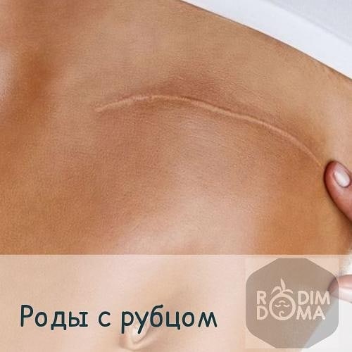 Роды с рубцом