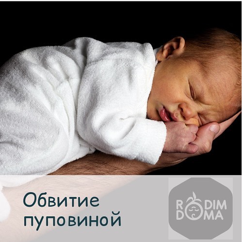 Обвитие пуповиной