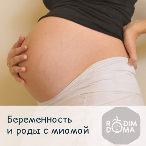 Беременность и роды с миомой